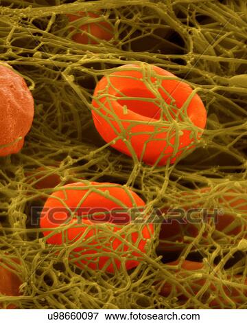 Stock Photo - Human red blood cells trapped in a fibrin blood clot, coloured scanning electron micrograph (SEM). Human red blood cells trapped in a fibrin blood clot. Platelets (not seen) are cell fragments in the blood that play an essential role in blood clotting.... Fotosearch