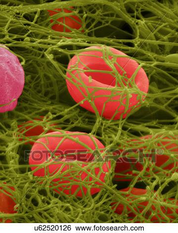Stock Photograph - Human red blood cells trapped in a fibrin blood clot, coloured scanning electron micrograph (SEM). Human red blood cells trapped in a fibrin blood clot. Platelets (not seen) are cell fragments in the blood that play an essential role in blood clotting.... Fotosearch