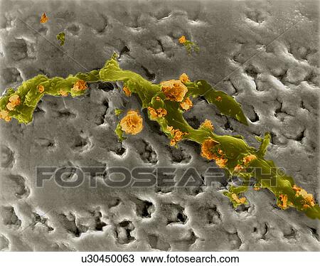 Stock Image - Human tooth with accumulation of bacterial plaque (smooth areas) and calcified tartar (rough areas) on enamel surface, coloured scanning electron micrograph (SEM). Plaque is the sticky, colourless film of bacteria that forms on teeth. You can sense.... Fotosearch