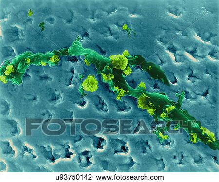 Stock Image - Human tooth with accumulation of bacterial plaque (smooth areas) and calcified tartar (rough areas) on enamel surface, coloured scanning electron micrograph (SEM). Plaque is the sticky, colourless film of bacteria that forms on teeth. You can sense.... Fotosearch
