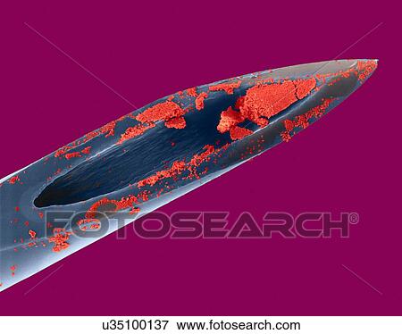 Stock Photo - Hypodermic needle (26 gauge) with human blood, coloured scanning electron micrograph (SEM). Red blood cells (RBCs), or erythrocytes, are the most common type of blood cell in vertebrates. They are involved in delivering oxygen to the body tissue. RBCs.... Fotosearch