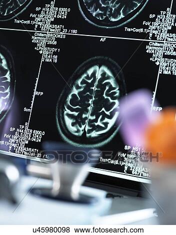Stock Photo - Magnetic resonance imaging (MRI) brain scans displayed on a screen on a doctor's desk.. Fotosearch
