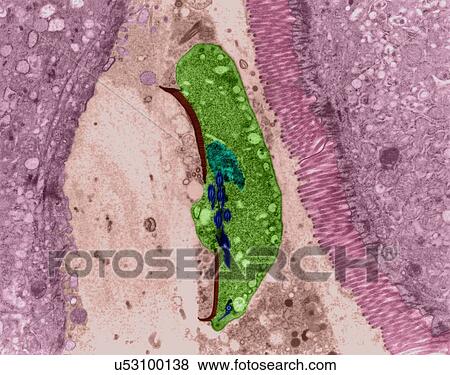 Stock Photo - Protozoan infection (giardiasis) in human intestinal lumen (Giardia sp. ), coloured transmission electron micrograph (TEM). Vegetative phase called trophozoite that develops from a cyst infection in the small intestine. Giardia lamblia, a human.... Fotosearch
