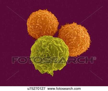 T lymphocytes (pre-T cells) and granulocyte (neutrophil), coloured scanning electron micrograph (SEM). Lymphocytes are involved in the specific immune response and are composed mainly of precursor T cells (pre-T cells) and B cells. Pre-T cells and B... View Large Photo Image Stock Photo - T lymphocytes (pre-T cells) and granulocyte (neutrophil), coloured scanning electron micrograph (SEM). Lymphocytes are involved in the specific immune response and are composed mainly of precursor T cells (pre-T cells) and B cells. Pre-T cells and B.... Fotosearch