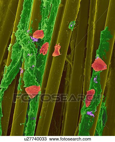 Stock Image - Used wax dental floss with dental plaque (green), bacteria (purple) and cheek cells (red) on the dental floss fibres (yellow), coloured scanning electron micrograph (SEM). Plaque consists of a biofilm of bacteria embedded in a glycoprotein matrix. The.... Fotosearch