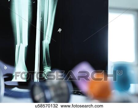 Stock Image - X-ray of a fractured leg displayed on a screen on a doctor's desk.. Fotosearch