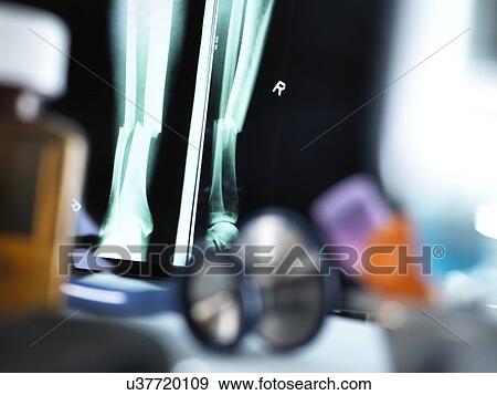 Stock Photo - X-ray of a fractured leg displayed on a screen on a doctor's desk.. Fotosearch