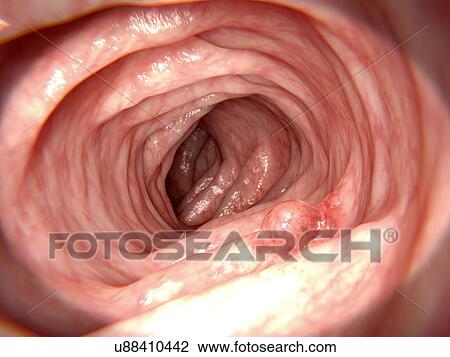 Stock Image - Adenomatous polyp, illustration. Fotosearch