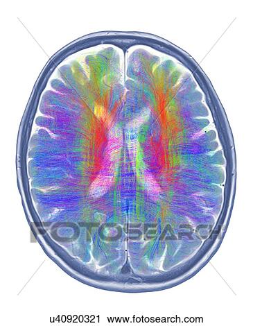 Stock Image - Brain MRI and white matter fibres. Fotosearch