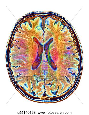 Brain MRI and white matter fibres View Large Photo Image Stock Image - Brain MRI and white matter fibres. Fotosearch