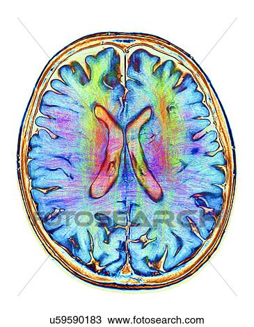 Brain MRI and white matter fibres View Large Photo Image Stock Image - Brain MRI and white matter fibres. Fotosearch