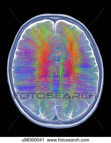 Stock Image - Brain MRI and white matter fibres. Fotosearch