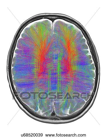 Stock Photo - Brain MRI and white matter fibres. Fotosearch
