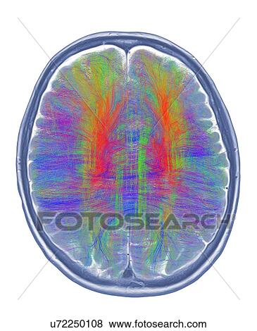 Brain MRI and white matter fibres View Large Photo Image Stock Photo - Brain MRI and white matter fibres. Fotosearch