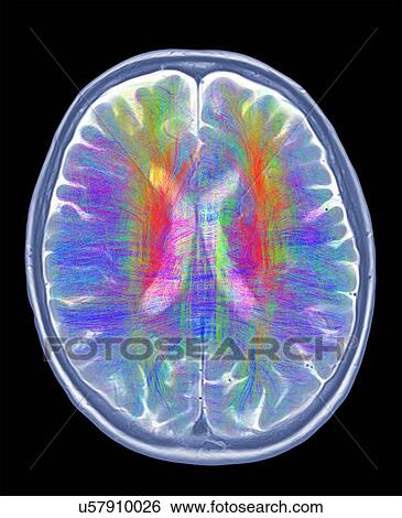 Stock Photograph - Brain MRI and white matter fibres. Fotosearch