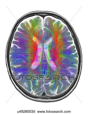 Brain MRI and white matter fibres View Large Photo Image Stock Photography - Brain MRI and white matter fibres. Fotosearch
