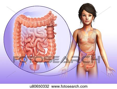 Stock Image - Child with diverticulosis, illustration. Fotosearch