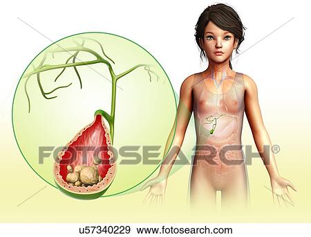 Stock Photo - Child with gallstones, illustration. Fotosearch