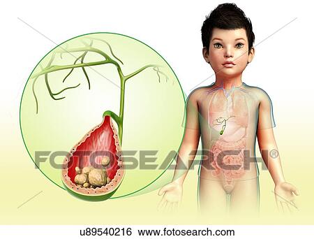 Child with gallstones, illustration View Large Photo Image Stock Photograph - Child with gallstones, illustration. Fotosearch