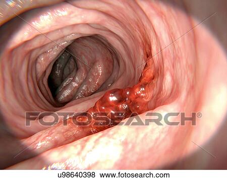 Colon cancer, illustration View Large Photo Image Stock Photo - Colon cancer, illustration. Fotosearch