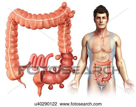 Man with diverticulosis, illustration View Large Photo Image Stock Image - Man with diverticulosis, illustration. Fotosearch
