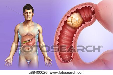 Stock Photograph - Man with intestinal cancer, illustration. Fotosearch