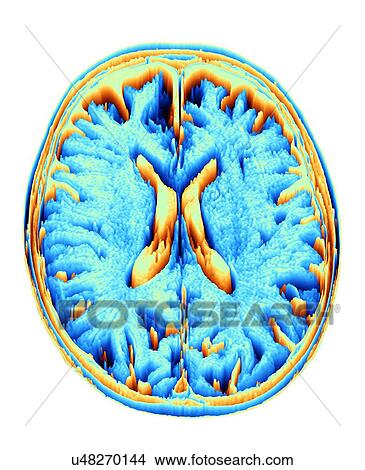Picture - MRI Brain scan, heightmap. Fotosearch