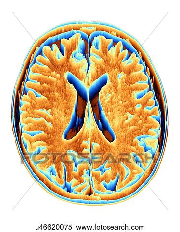 Stock Photography - MRI Brain scan, heightmap. Fotosearch