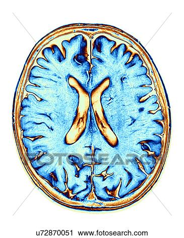 MRI Brain scan of the human head View Large Photo Image Stock Image - MRI Brain scan of the human head. Fotosearch