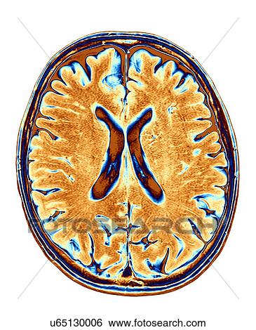 Stock Photograph - MRI Brain scan of the human head. Fotosearch