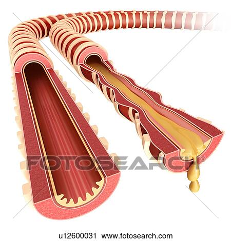 Stock Image - Normal and infected lung bronchi, illustration. Fotosearch