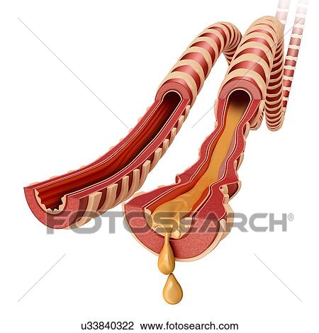 Stock Image - Normal and infected lung bronchi, illustration. Fotosearch