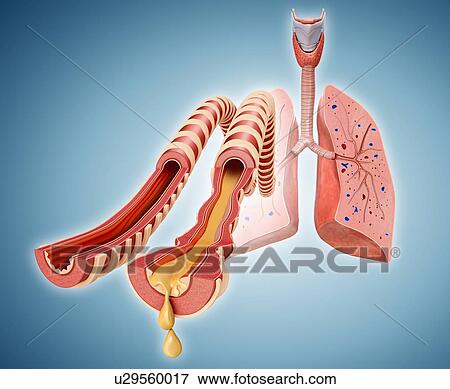 Stock Photo - Normal and infected lung bronchi, illustration. Fotosearch