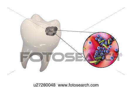 虫歯 そして バクテリア イラスト 写真館 イメージ館 U Fotosearch