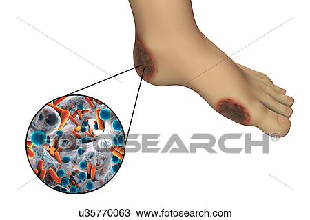 Stock Image - Destruction of Cytomegalovirus, illustration. Fotosearch