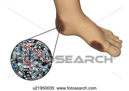 Stock Photography - Destruction of Cytomegalovirus, illustration. Fotosearch