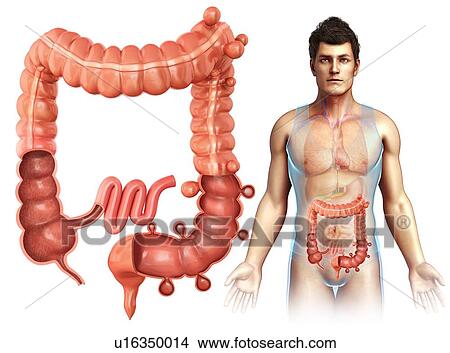 Picture - Diverticulosis disease, illustration. Fotosearch