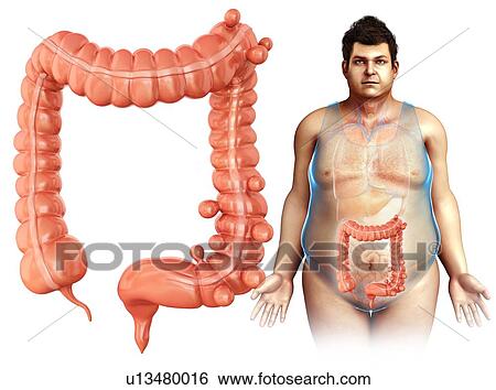 Stock Photograph - Diverticulosis disease, illustration. Fotosearch