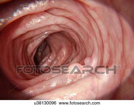 Stock Photograph - Intestinal polyps, illustration. Fotosearch