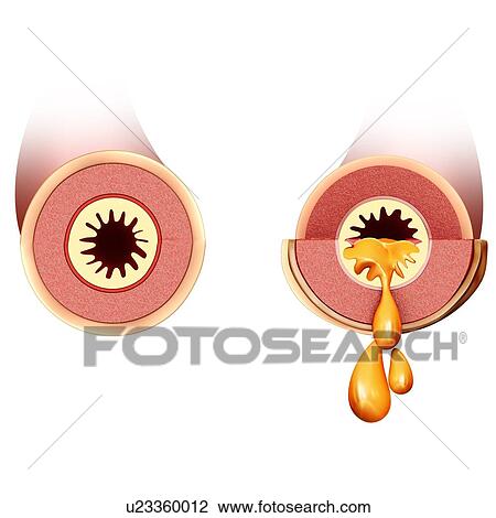 Normal and infected bronchi, illustration View Large Photo Image Stock Image - Normal and infected bronchi, illustration. Fotosearch