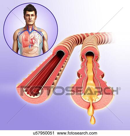Stock Image - Normal and infected bronchi, illustration. Fotosearch