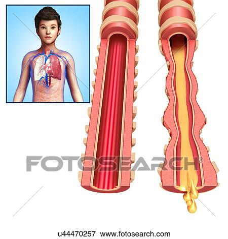 Normal and infected bronchi, illustration View Large Photo Image Stock Photo - Normal and infected bronchi, illustration. Fotosearch