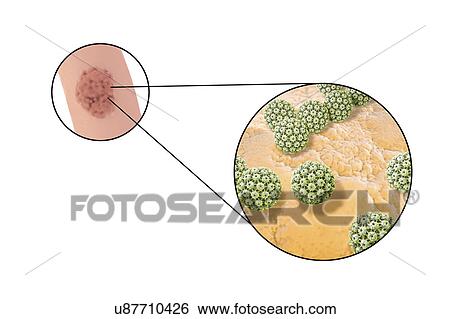 Penile warts and human papilloma virus, illustration View Large Photo Image Stock Photograph - Penile warts and human papilloma virus, illustration. Fotosearch