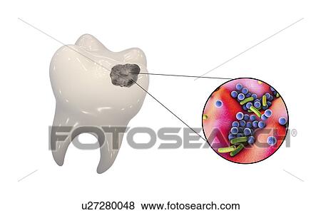 Tooth decay and bacteria, illustration View Large Photo Image Stock Photo - Tooth decay and bacteria, illustration. Fotosearch
