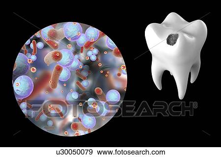 Stock Photo - Tooth decay and bacteria, illustration. Fotosearch