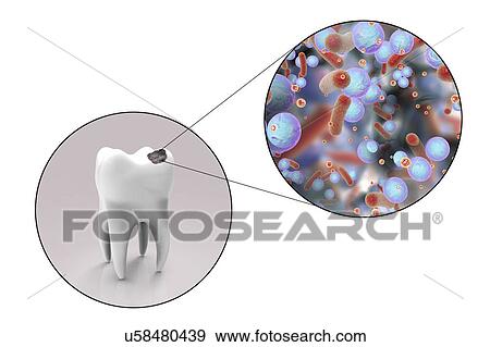 Tooth decay and bacteria, illustration View Large Photo Image Stock Photo - Tooth decay and bacteria, illustration. Fotosearch