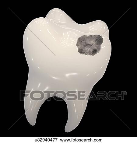 Stock Photo - Tooth decay, illustration. Fotosearch