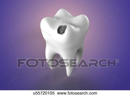 Tooth decay, illustration View Large Photo Image Stock Photography - Tooth decay, illustration. Fotosearch