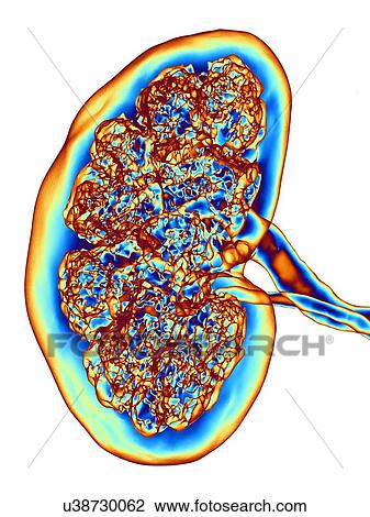 Stock Image - Kidney, CT scan. False colour 3-D computed tomography (CT) scan of a kidney in frontal view.. Fotosearch