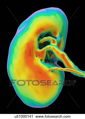 Kidney, CT scan. False colour 3-D computed tomography (CT) scan of a kidney in frontal view. View Large Photo Image Stock Image - Kidney, CT scan. False colour 3-D computed tomography (CT) scan of a kidney in frontal view.. Fotosearch